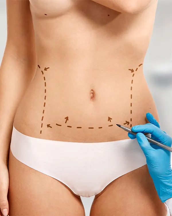 Img-Dra_Yolanda_Parales-Procedimiento-Abdominoplastia