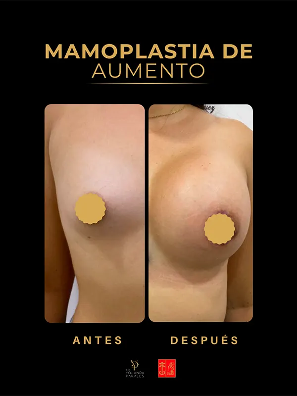 Img-Dra_Yolanda_Parales-Antes_&_Despues-Mamoplastia_aumento-1